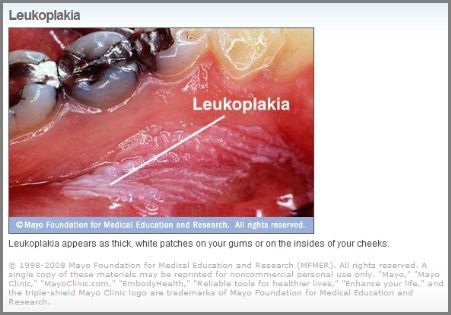 However, smokeless tobacco can cause cancer!